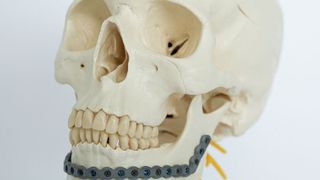 Osteosynthesis implant for a lower jaw, equipped with a porous surface created using micro-arc oxidation. (Image:Fraunhofer IFAM)