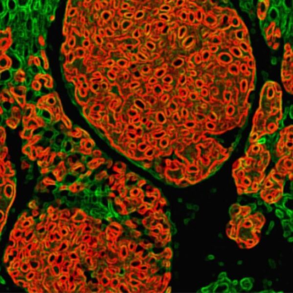 Abb. 2: Immunofluoreszenz-Analyse von Hautgewebe mit Melanom (rot: Tumornester). (Bild: Hans-Uwe Simon, Institut für Pharmakologie, Universität Bern)