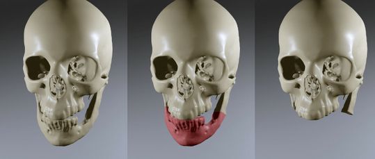 (Bild 3: 3D-Darstellung eines Patienten mit entzündetem Unterkiefer. Der betroffene Bereich wird vor der Rekonstruktion mit 3D-gedruckter Resektionsschablonen entfernt. Bild: Inzipio)