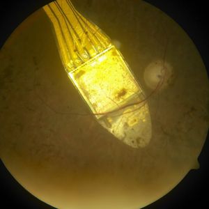 Zu sehen ist hier ein subretinales Alpha IMS Implantat auf dem hinteren Augenpol bei Retinitis pigmentosa.