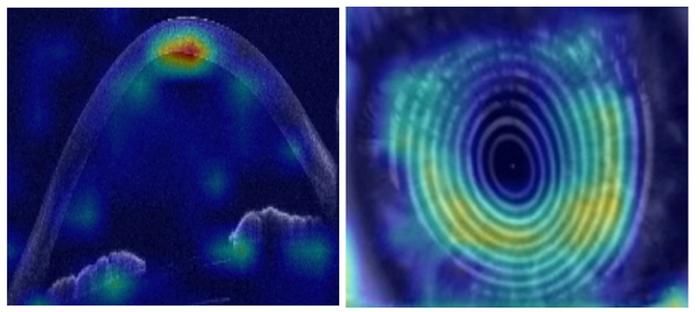  KI gegen Augenerkrankung    Keratokonus ist eine Augenerkrankung, die häufig bei Jugendlichen auftritt und sich im Erwachsenenalter verschlechtert. Sie führt dazu, dass die Hornhaut sich wölbt und das Sehvermögen beeinträchtigt, oft mit der Notwendigkeit einer Hornhauttransplantation. Forscher haben nun Künstliche Intelligenz (KI) erfolgreich eingesetzt, um vorherzusagen, welche Patienten sofortige Behandlung benötigen, um ihr Sehvermögen zu stabilisieren.  Die KI analysierte Augenbilder und Patienteninformationen, um Patienten in zwei Gruppen zu kategorisieren: diejenigen, die behandelt werden müssen, und diejenigen, die nur überwacht werden müssen. Mit Hilfe von optischer Kohärenztomografie (OCT) und Daten von 6.684 Patienten konnte die KI bereits beim ersten Besuch zuverlässig das Risiko einer Krankheitsverschlechterung abschätzen. Zwei Drittel der Patienten wurden als risikoarm eingestuft, die keine Behandlung benötigten. Die Forscher konnten durch ihre Methode bis zu 90% der Patienten korrekt klassifizieren. Diese Technologie könnte helfen, unnötige Kontrollen zu reduzieren und Behandlungen rechtzeitig durchzuführen, um Sehverlust zu verhindern. Ein verbesserter KI-Algorithmus wird derzeit entwickelt, um weitere Augenkrankheiten zu diagnostizieren.  Das Bild zeigt ein Beispiel eines OCT-Scans des Auges, das von der KI verwendet wird.  Bildquelle: Shafi Balal / ESCRS  ,  (CC BY SA)   Hier gehts zur Originalmeldung Wissenschaftsbild des Tages vom 16.9.2025  (Bild: Shafi Balal / ESCRS)