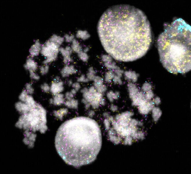 Evolution von DNA-Ringen im Neuroblastom   Tumore verhalten sich manchmal eigenartig: Sie wachsen außergewöhnlich stark oder werden plötzlich gegen ein Krebsmedikament resistent. Dieses Verhalten lässt sich häufig darauf zurückführen, dass sich Krebsgene aus den Chromosomen der Zelle herauslösen und in Ringform „selbständig machen“. Wenig ist bisher darüber bekannt, wie genau diese DNA-Ringe entstehen und wie sie sich im Verlauf des Tumorwachstums weiterentwickeln. Mit einer neuen Methode hat ein internationales Forschungsteam unter Leitung der Charité – Universitätsmedizin Berlin und des Max Delbrück Centers diesen Weg jetzt bei dem Neuroblastom nachgezeichnet.  Das Bild zeigt Kerne und Chromosomen von Neuroblastomzellen. DNA-Ringe sind gelb, türkis oder magenta angefärbt. Jede Farbe signalisiert unterschiedliche Krebsgene.   Hier gehts zur Originalmeldung Wissenschaftsbild des Tages vom 11.5.2023 (Charité | Rocío Chamorro González)
