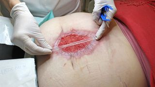 Meding stellt im Kundenauftrag einen neuen, transparenten Wundspatel fürs Débridement her. Für die gewünschte Kontrolle des Wundverlaufs ist eine Messskala eingearbeitet. (Meding)