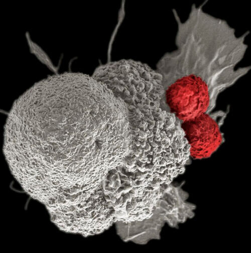 A pseudo-colored scanning electron micrograph of an oral squamous cancer cell (white) being attacked by two cytotoxic T cells (red). 