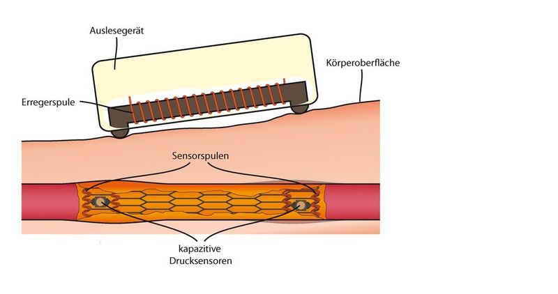 Das Übertragungssystem: Das Schnelldiagnosesystem besteht aus einem in den Stent integrierten passiven Teil und einem aktiven Auslesegerät, das von außen am Körper appliziert wird. (Bild: Fraunhofer IPA)
