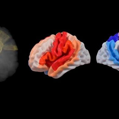 When a stroke damages brain tissue (red) along an important movement pathway (yellow), the injured side of the brain may show faster aging (red), while parts of the opposite side may appear relatively “younger” (blue) as the brain tries to compensate. This pattern is linked to more severe movement problems and less recovery.
 (Bild: Stevens INI)