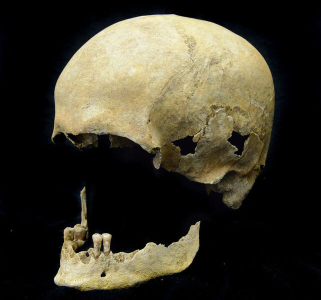 Skeletal remains of HBV positive individual from the medieval site of Petersberg, Germany, it is from a male with an age at death of around 65-70 years. (Ben Krause-Kyora)