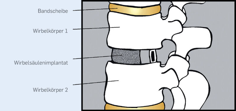 Bild 2 | Prinzip des Wirbelsäulenimplantats: Für den kompletten Bandscheibenersatz wird das Implantat zwischen zwei Wirbelkörpern platziert. Es verbindet sich mit den Knochen, sodass der Wirbelsäulenabschnitt versteift wird (Bild: Ruhr Universität Bochum)