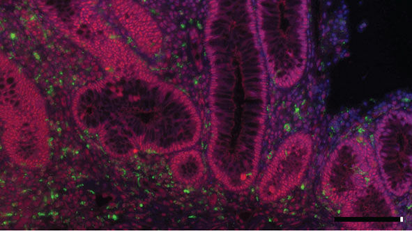 Intestine of a patient with ulcerative colitis, a chronic inflammatory disease of the intestine. Macrophage marker is shown in green, activated p38 protein in red, and nucleus in blue.  (Catrin Youssif, IRB Barcelona  )