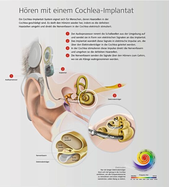 Ein Cochlea-Implantat eignet sich für Menschen, deren Haarzellen in der Cochlea geschädigt sind. (Med-El)
