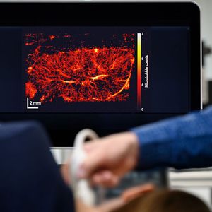 In der Ultraschall-Lokalisations-Mikroskopie des gesunden Lymphknotens am Hals einer Versuchsperson kann man die einzelnen Gefäße deutlich erkennen.(Bild:  Roberto Schirdewahn)