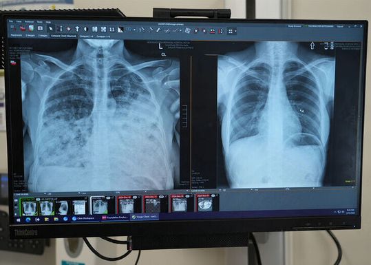 Lung cancer patient scans before and after transplant.(Source:  Northwestern University)