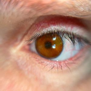 Nahaufnahme der 3D-gedruckten Augenprothese