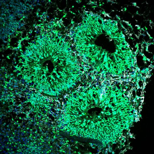 Menschliches Gehirnorganoid mit Ventrikeln, die aus neuralen Vorläuferzellen (grün) und neugeborenen Neuronen (grau) bestehen Menschliches Gehirnorganoid mit Ventrikeln, die aus neuralen Vorläuferzellen (grün) und neugeborenen Neuronen (grau) bestehen