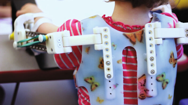 Eine speziell angepasste, 3D-gedruckte Version des Wilmington Robotic Exoskeleton (WREX) ermöglicht der kleinen Emma, ihre Arme trotz Arthogryposis zu bewegen. (Bild: Stratasys)