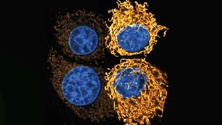 Krebszellen verändern die Form ihrer Mitochondrien (gelb), in saurer Umgebung. Das zusammengesetzte Bild zeigt zwei Zellen unter neutralem pH-Wert (l.) im Vergleich zu einer sauren Umgebung (r.), in der die Mitochondrien längliche Netzwerke bilden.  (Bild: Groessl / DKFZ)