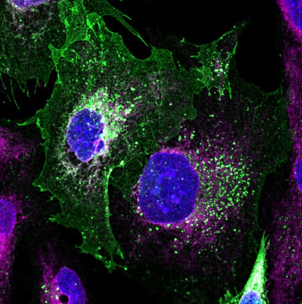 Nieren-Reparatur  Die seltene Nierenkrankheit SRNS (steroid-resistentes nephrotisches Syndrom) schwächt die Niere und betrifft vor allem Kinder. Da die Erkrankung erblich ist, gibt es keine Wirkstoffe dagegen. Eine mögliche Therapieform ist es, die genetischen Mutationen zu reparieren. Dazu haben Forscher der School of Biochemistry in Bristol/England nun ein neues „DNA-Reparatur-Kit“ entwickelt. Sie nutzen gentechnisch modifizierte Baculoviruen als Vehikel für die Gentherapie von SRNS. Das Bild zeigt Nierenzellen eines Patienten, die mit dem neuen Baculovirus-Vektoren-Ansatz repariert wurden. Grün gefärbt ist das Protein Podocin, welches bei SRNS geschädigt wird. Hier wurde es durch die Gentherapie wie in gesunden Zellen wiederhergestellt. Hier gehts zur Originalmeldung Wissenschaftsbild des Tages vom 4.8.2022 (Dr. Francesco Aulicino)