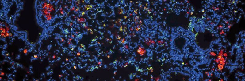 Die Mikroskopaufnahme eines Lungenschnittes einer mit Tuberkulose (TB) infizierten Maus zeigt in Rot die Wirkstoff-Nanopartikel, in Blau die Kerne der Lungenzellen, und in Grün die Fresszellen oder Makrophagen, deren Aufgabe es eigentlich ist, Krankheitserreger zu beseitigen, die aber von den TB-Bakterien als Wirtszelle ausgenutzt werden.