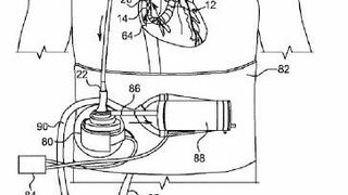 Doppellumen-Drainagekanüle mit internem Durchflussbegrenzer (Bild: CardiacAssist/DPMA)
