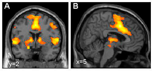 Aktivierung des Furchtnetzes im Gehirn, dargestellt mittels funktioneller Kernspintomografie (Dr. Tina Lonsdorf, Systemische Neurowissenschaften UKE Hamburg)