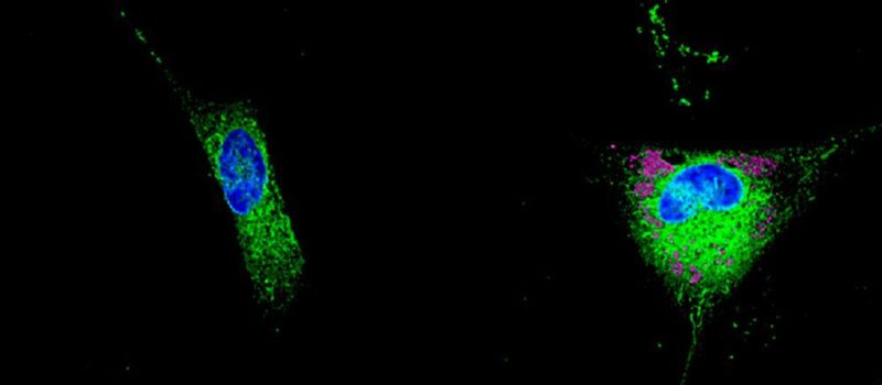 An astrocyte that stores lipids in droplets (pink) and starts secreting toxic lipids in the surrounding tissue.  (© Unige / A.-C. Gavin	)