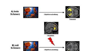 A) Visuelle Reize (Objekte) werden in der Sehrinde verarbeitet und führen dort zu einer starken Aktivierung. B) Bei Schmerzreizen kommt es zu einer direkten Störwirkung des Schmerzsystems (aus dem Cingulum) auf die Sehrinde. Die Verarbeitung von Bildern/Objekten wird gestört.  (Foto: U. Bingel)