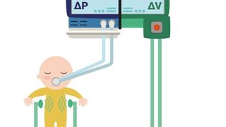 Schema des Thorax-Monitors im Betrieb: Die Atmung des Frühchens wird berührungslos gemessen. Diese Daten sollen zusammen mit den übrigen Messwerten des Beatmungsgeräts zu einer schonenden und effizienteren Beatmung führen. (Fraunhofer IPA)