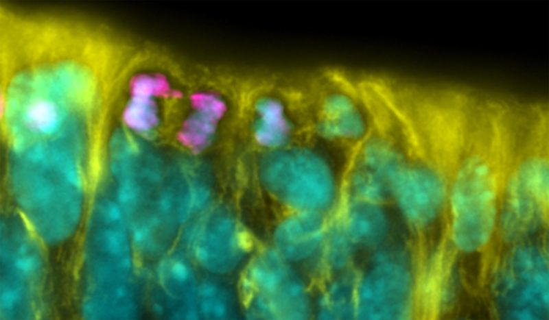 Genetische Schreibfehler vermeiden Bestimmte Entwicklungssignale prägen nicht nur den menschlichen Embryo, sondern spielen auch eine wichtige Rolle bei der Erhaltung unseres genetischen Bauplans. Sie verhindern Veränderungen im Genom, den so genannten Mosaizismus. Diese Entdeckung machte ein internationales Forscherteam unter Leitung von Wissenschaftlern des Centre for Organismal Studies der Universität Heidelberg bei Untersuchungen mit Stammzellen. Der zugrundeliegende biologische Mechanismus hilft der DNA, bei der Zellteilung eine identische Kopie von sich selbst unter Verwendung des ursprünglichen genetischen Bauplans herzustellen. Er kann aber auch zu genomischem Mosaizismus während der Nervenzellentwicklung beitragen, wie die Forscher berichten    Das Bild zeigt Chromosomensegregationsfehler in einer sich teilenden neuralen Stammzelle (magenta) während der Neurogenese im sich entwickelnden Gehirn einer Maus. Für ihre Studie untersuchten die Wissenschaftler Zehntausende von Stammzellteilungen.  Hier gehts zur Originalmeldung Wissenschaftsbild des Tages vom 1.10.2024   (Bild: Janina Hattemer and Sergio Acebrón)