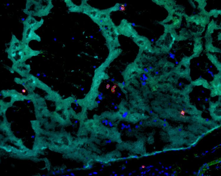 Eosinophile Granulozyten (rote Zellen) tragen innerhalb einer Thrombose (sog. Thrombozyten sind in türkis gefärbt) zum Thrombuswachstum bei. (FAU/Jochen Ackermann)