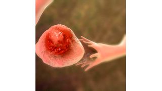 Northwestern Medicine scientists have discovered the Achilles heel of chemotherapy-resistant ovarian cancer — its hunger for cholesterol — and how to sneakily use that to destroy it. (Source: Dr_Microbe - stock.adobe.com)