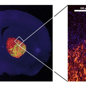 Abb. 3: Ein Querschnitt durch das Gehirn (blau) einer Maus, die an einem bösartigen Hirntumor (rot) erkrankt ist. Das modifizierte VSV (VSV-GP, gelb) wurde der Maus drei Tage zuvor intravenös gespritzt. 