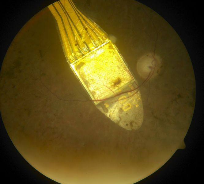 Zu sehen ist hier ein subretinales Alpha IMS Implantat auf dem hinteren Augenpol bei Retinitis pigmentosa. (Bild: Department für Augenheilkunde, Uni Tübingen)