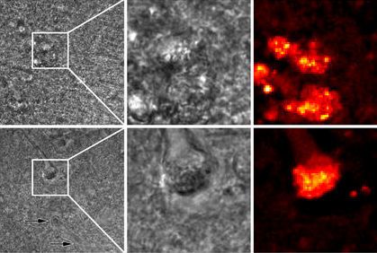 The high-lighted squares (left) are the 30 by 30 micron areas in the middle and right images (upper: plaque, lower: tangle) (University of Twente)
