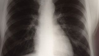 Röntgenaufnahme der Lunge (Bild: ILL)