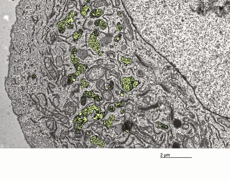 À l'intérieur : les nanoparticules de dioxyde d'hafnium (colorées en jaune-vert) s'accumulent dans les cellules cancéreuses et peuvent provoquer des dommages cellulaires après irradiation. 