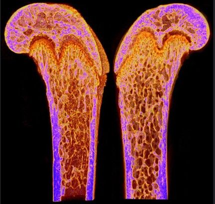 Das Knochen-Kommunikationsnetzwerk  An der ETH Zürich haben Forscher unter Leitung von Professor Ralph Müller eine spannende Entdeckung gemacht: Altern macht den Knochen bei männlichen Mäusen mehr zu schaffen als bei weiblichen. Sie nutzten ein spezielles Mausmodell namens PolgD257A/D257A, um diese Unterschiede zu erforschen. Im Mittelpunkt der Studie stehen Osteozyten, eine Art spezialisierte Knochenzellen, die für den Erhalt stabiler Knochen unerlässlich sind. Mit der Zeit bricht das Kommunikationsnetzwerk dieser Zellen zusammen, was zu schwächeren und brüchigeren Knochen führt. Besonders männliche Mäuse zeigten stärkere Anzeichen dieser degenerativen Veränderungen. Die Forscher setzen modernste Bildgebungsverfahren ein, um die Abläufe im Maus-Knochen zu untersuchen und sehen dabei parallelen zur menschlichen Knochenalterung. Diese Erkenntnisse sind ein wichtiger Schritt zur Entwicklung neuer Behandlungsansätze gegen Osteoporose. Die Studie zeigt, wie wichtig es ist, Osteozyten und ihr Netzwerk zu verstehen, um die Knochengesundheit im Alter zu erhalten und gezielte Therapien zu entwickeln. Hier gehts zur Originalmeldung Wissenschaftsbild des Tages vom 24.6.2025  (Bild: National Institute of Arthritis and Musculoskeletal and Skin Diseases (NIAMS), Laboratory of Skin Biology, Maria I. Morasso, Ph.D., Chief National Institutes of Health)