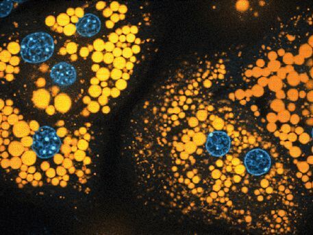 Aufnahme von Leberzellen, die voller Fett-Tröpfchen (orange) sind. In blauer Farbe sind die Zellkerne abgebildet. (K. Piotrowitz/AG Thiele)