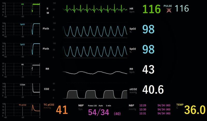 Das Fenster Vitalparameter-Monitor zeigt die Ergebnisse der Behandlung in Echtzeit an. Der Monitor lässt sich so konfigurieren, dass er mit dem jeweiligen System des Krankenhauses übereinstimmt. (Neosim)