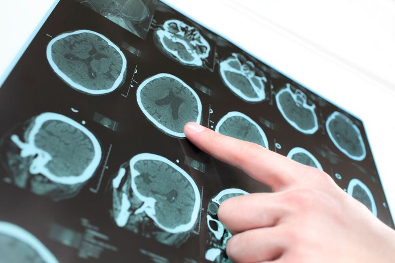 Die Hirnforschung beschäftigt eine besondere Form von Epilepsie, die immunvermittelt ist. Ein FWF-Projekt konnte jetzt zwei dafür verantwortliche Schadensprozesse identifizieren. (Quelle: Shutterstock/ sfam_photo)