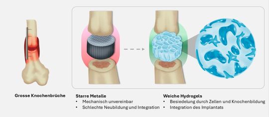 Um Knochen zu verbinden, werden heute harte steife Implantate verwendet (l.). Künftig könnten weiche Implantate aus einem Hydrogel eingesetzt werden.(Grafik: Xiao-Hua Qin / ETH Zürich)