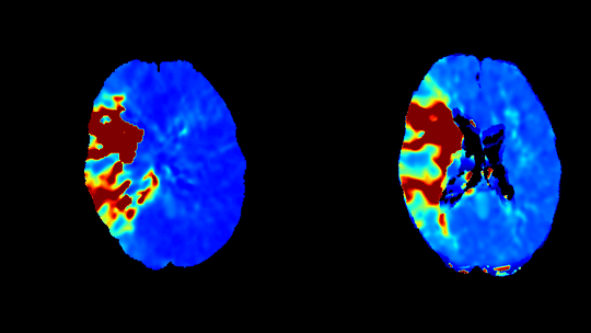 Tmax Perfusionskarten: Links die Cone Beam CT Perfusion, rechts im Vergleich dazu die konventionelle CT Perfusion.(Bild:  Prof. Johannes Kaesmacher, Inselspital, Universitätsklinikum Bern, Schweiz)