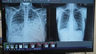 Lung cancer patient scans before and after transplant. (Source: Northwestern University )
