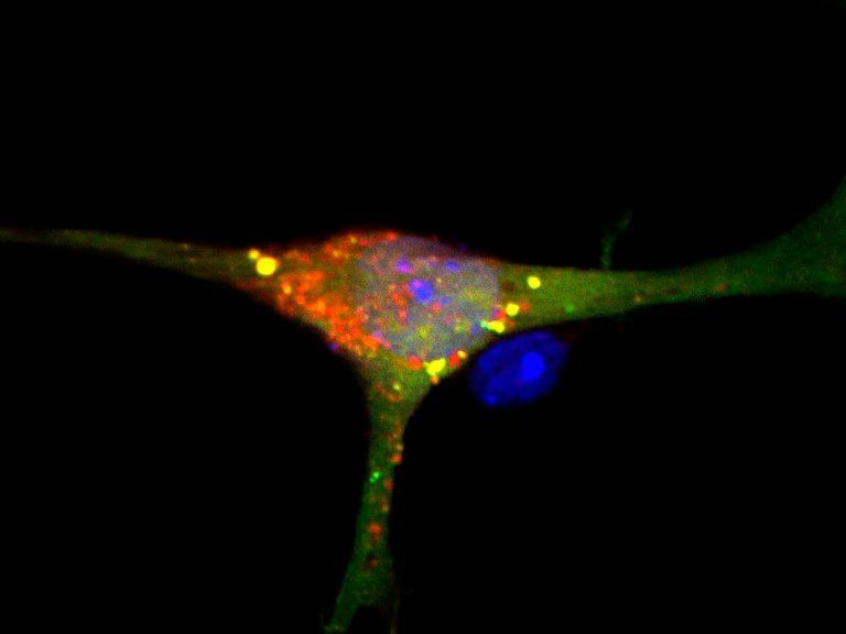 Nervenzelle mit gestörtem S1P-Abbau: Die gelb-orange markierten Müllsäcke haben sich nicht geschlossen, sondern sind durchlässig.  (© AG van Echten-Deckert/Uni Bonn)