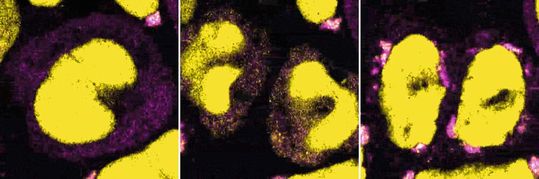 Nachdem UV-Strahlung Schäden an der RNA verursacht hat, bilden die Proteine DHX9 (gelb) und G3BP1 (violett) Stressgranula, und zwar nachdem sich die Zelle geteilt hat.  (Bild:  MPI für Immunbiologie und Epigenetik/ Akhtar)