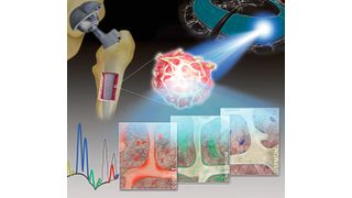 Räumlich hochaufgelöste Synchrotron-Röntgenfluoreszenzanalysen von humanen Knochen- und Knochenmark-Biopsien zeigen die spezifischen Verteilungsmuster von Metallen (Kobalt, Chrom und Titan), die aus Legierungen von Endoprothesen freigesetzt werden. (Bild: Naujok/ Charité)