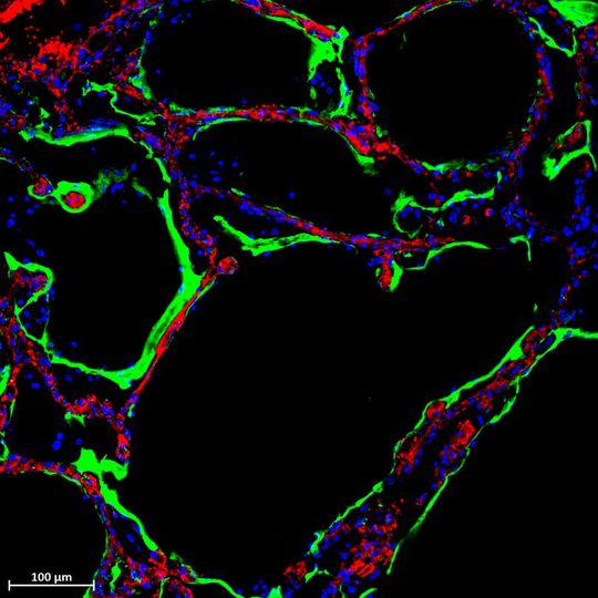 Immunofluorescent staining shows expression of the new SARS-CoV-2 Spike-receptor LRRC15 (green) in post-mortem lung tissue section from individual with Covid-19. Immunofluorescent staining shows expression of the new SARS-CoV-2 Spike-receptor LRRC15 (green) in post-mortem lung tissue section from individual with Covid-19.