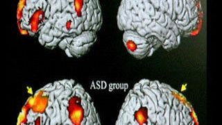 Hirnscan mit markierten Arealen: Bei Autisten ist beim Erkennen der Emotionen andere Areale aktiv.  (Bild: WDR)