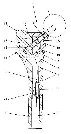 Eine Prothese(Bild:  mechamed GmbH/DPMA)
