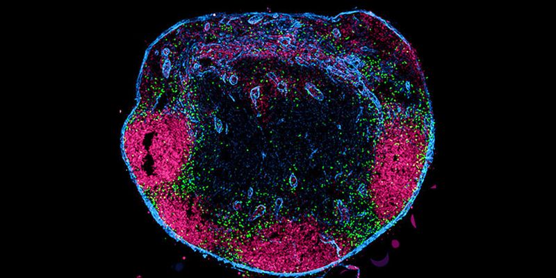 Unkonventionelle T-Zellen  Der menschliche Körper enthält 600 bis 800 Lymphknoten. Sie sind darauf spezialisiert, Immunantworten auszulösen. Damit die Lymphknoten über Infektionen im Körper informiert werden, sind sie über Lymphgefäße mit den einzelnen Organen verbunden. Von dort transportieren die Lymphgefäße Flüssigkeit, aber auch spezielle Immunzellen in die Lymphknoten. Diese Immunzellen heißen dendritische Zellen; sie tragen Informationen aus den Organen in die Lymphknoten und geben sie dort an andere Immunzellen weiter.  Jetzt steht fest: Die dendritischen Zellen sind nicht allein für diesen wichtigen Informationsfluss zuständig. Ein Forschungsteam um den Immunologen Professor Wolfgang Kastenmüller von der Julius-Maximilians-Universität (JMU) Würzburg hat herausgefunden, dass auch so genannte „unkonventionelle T-Zellen“ kontinuierlich vom Gewebe in die Lymphknoten wandern und dort die Immunantworten beeinflussen.  Das Bild zeigt den Querschnitt durch einen Lymphknoten. Die unkonventionellen T-Zellen (grün), die über die Lymphbahnen aus dem Gewebe eingewandert sind, befinden sich im Randsinus und in der interfollikulären Zone. Follikuläre B-Zellen sind magenta dargestellt, die Lymphknotenkapsel und lymphatischen Gefäße in blau. Hier gehts zur Originalmeldung Wissenschaftsbild des Tages vom 8.9.2022 (Konrad Knöpper / Universität Würzburg )