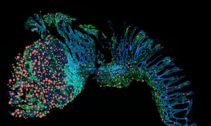 Treiber der Krebsentwicklung  Chronisch-entzündliche Darmerkrankungen (CED) wie Colitis ulcerosa und Morbus Crohn sind schwer behandelbar und bergen das Risiko von Komplikationen, einschließlich Darmkrebs. Besonders betroffen sind junge Menschen im Alter von 15 bis 29 Jahren, bei denen genetische Veranlagungen und bestimmte Faktoren zusammenwirken.  Forscher der Charité - Universitätsmedizin Berlin haben nun einen neuen Ansatz entdeckt, um die anhaltenden Entzündungen zu stoppen. Zwei Botenstoffe des Immunsystems stehen dabei im Fokus: Interleukin-22 und Oncostatin M. Interleukin-22 stärkt die Darmschutzbarriere, während Oncostatin M Entzündungen fördert und eine Kettenreaktion der Immunantwort auslöst. Hohe Werte von Oncostatin M können das Versagen herkömmlicher Therapien vorhersagen. Die Blockade der Oncostatin M-Rezeptoren zeigt jedoch eine vielversprechende Reduktion der chronischen Entzündung und des assoziierten Krebsrisikos – eine Hoffnung für Hochrisikopatienten.  Das Bild zeigt die Treiber der Krebsentwicklung: Der entzündliche Botenstoff Oncostatin M kann vermehrt in der Nähe von Tumoren (rot), weniger jedoch im gesunden Darmgewebe mit normaler Zellstruktur (rechts) beobachtet werden. Hier gehts zur Originalmeldung Wissenschaftsbild des Tages vom 05.6.2025 (Bild: Charité | Ahmed Hegazy)